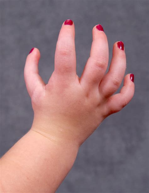 Finger Hand Follow Up Congenital Hand And Arm Differences Washington University In St