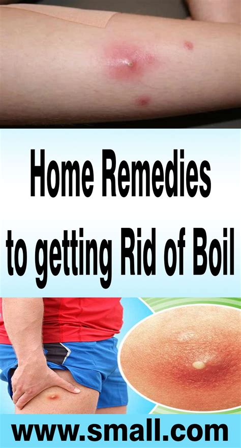Home Remedies To Get Rid Of Boil Home Remedies Remedies