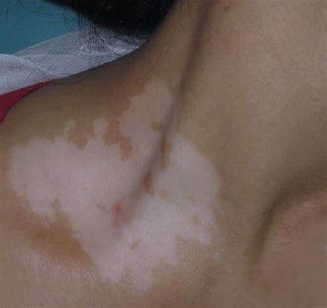 What Are The White Spots After You Tan Your Skin