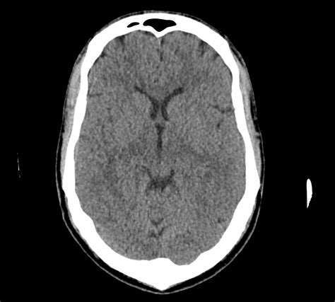 Normal Ct Brain Radiology Case