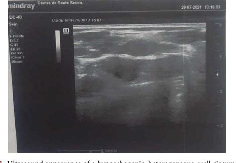 Figure 1 From Epidermal Inclusion Cyst A Rare Benign Breast Lesion