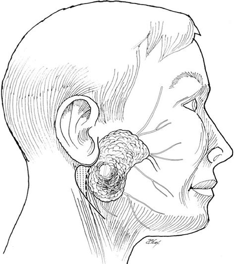 Parotidectomy Incisions Operative Techniques In Otolaryngology Head