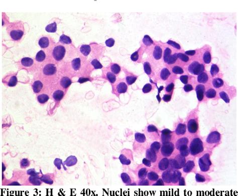 Figure 3 From Cytology Based Diagnosis Of Lobular Carcinoma Of Breast