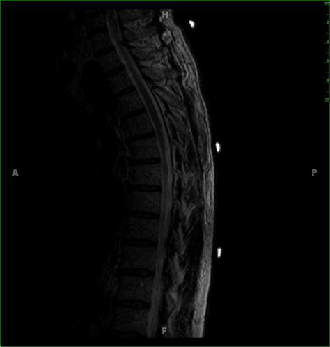 Thoracic Spinal Cord Cavernoma Neuro Mr Case Studies Ctisus Ct Scanning