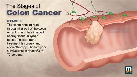 Stages Of Colon Cancer Youtube