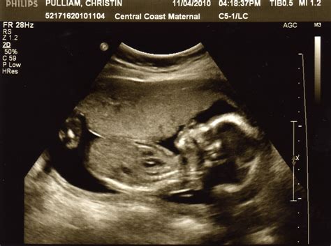 Seven Is Our Lucky Number Ultrasound 19 Weeks