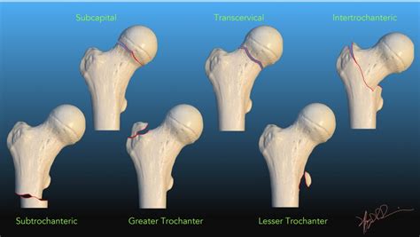 Femoral Neck Fracture Nomenclature UW Emergency Radiology