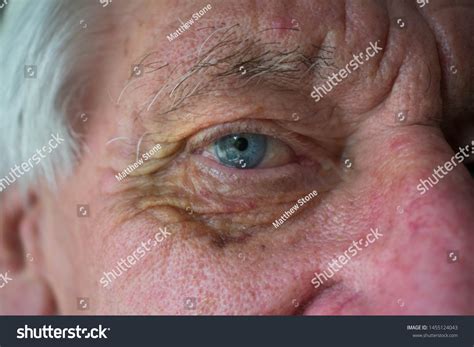 641 Hematoma Face Images Stock Photos And Vectors Shutterstock