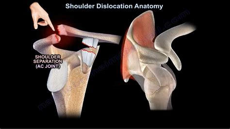 Shoulder Dislocation Anatomy Bipmd