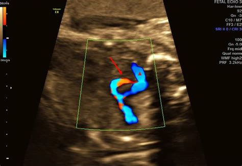 Fetal Echocardiogram At 28 Weeks And 4 Days Gestation Demonstrates An