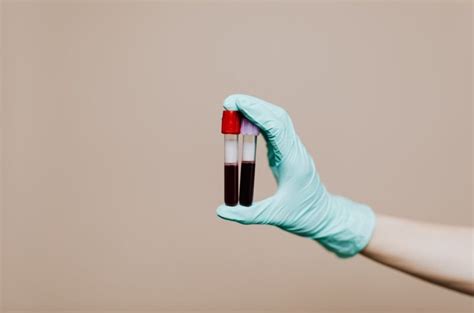 Morfologia Krwi O Czym M Wi To Badanie Krwi Zwrotnikraka Pl