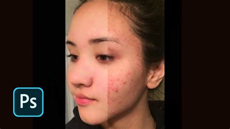 Remove Acne In Easy Steps With Photoshop Youtube