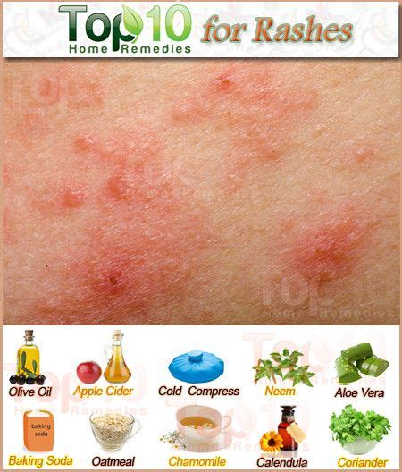 Allergy Trigger How To Treat Allergic Reaction Rash Naturally