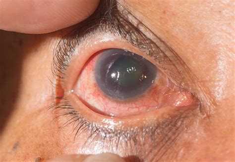 In people with glaucoma, a buildup of fluid causes pressure in the eye to increase. ¿Qué es el Glaucoma? - Área Oftalmológica Avanzada