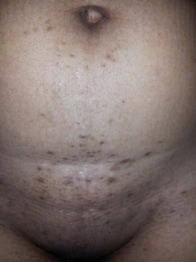 She did however take the day off the day after the stuffing, suffering from a relentless stomach ache all day and being incredibly nauseous. How do i remove dark spots from my legs and stomach ...