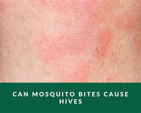 Can Mosquito Bites Cause Hives Zero Pest Ng