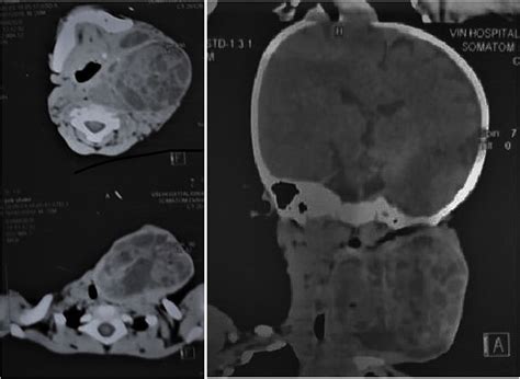 Figure 2 From Mature Cystic Teratoma Of The Neck Misdiagnosed At Cystic