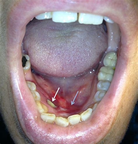 Painful Ulcer On Floor Of Mouth Viewfloor Co