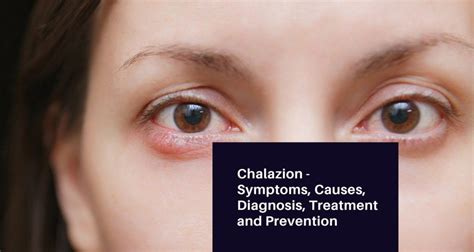 Chalazion Symptoms Causes Diagnosis Treatment And Prevention