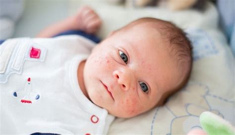 10 Cara Menghilangkan Bintik Merah Di Wajah Bayi Okezone Health