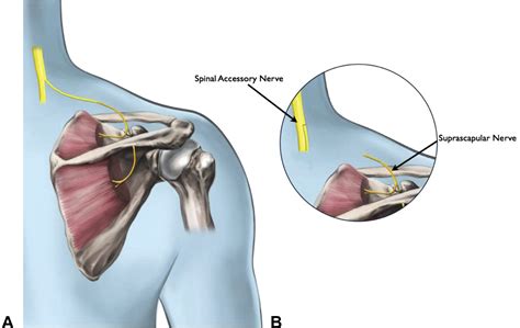 Open Anterior Release Of The Superior Transverse Scapular Ligament For