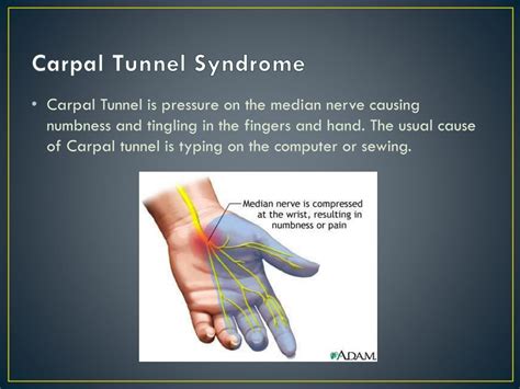 Ppt Carpal Tunnel Syndrome Causes Symptoms And Treatm