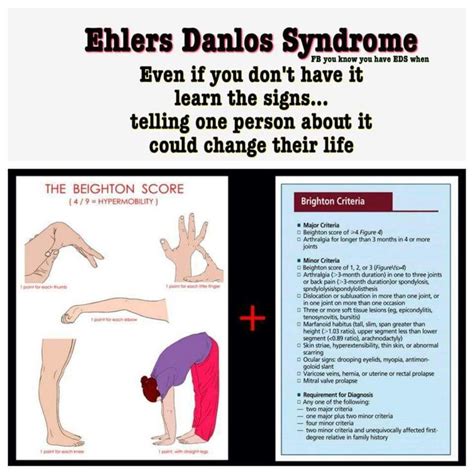 Eds Ehlers Danlos Syndrome Awareness Ehlers Danlos Syndrome Ehlers