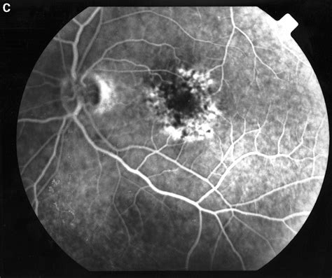 Ocular abnormalities in thin basement membrane disease 
