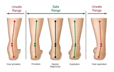 Overpronation Of Foot