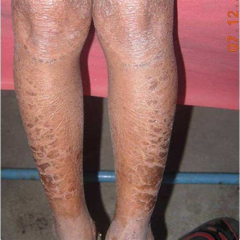 Scaly Circumscribed Plaques With Follicular Papules On Knees Anterior