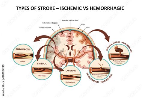Types Of Stroke Ischemic Vs Hemorrhagic Stock 벡터 Adobe Stock