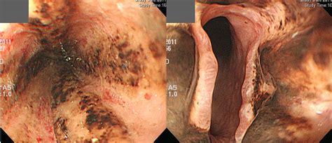 When untreated, the dying cells release substances that lead to the death of surrounding cells, so untreated necrosis can lead to death. Acute esophageal necrosis (AEN). EndoTODAY 이준행