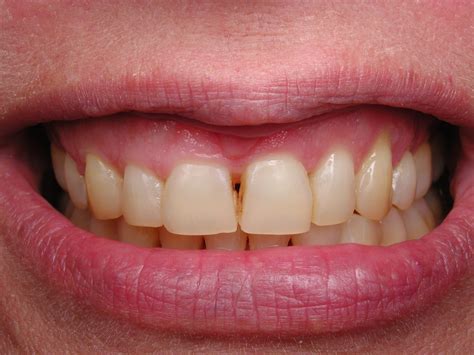 How long does a cavity filling take? White Fillings and Bonding