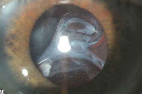 Sudden Visual Loss Intraocular Lens Subluxation Bmj Case Reports