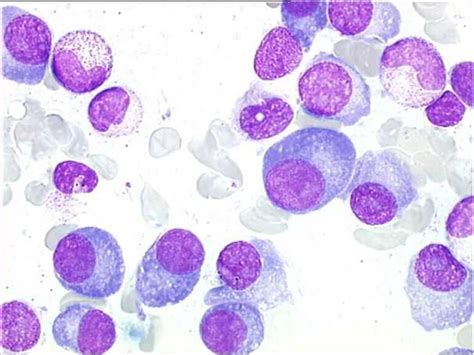 Multiple Myelomaplasma Cells W Eccentric Nuclei Dark Blue Cytoplasm