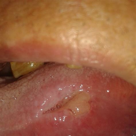 Ulcerated Lesion Of Left Lateral Border Of Tongue Photograph Was Taken