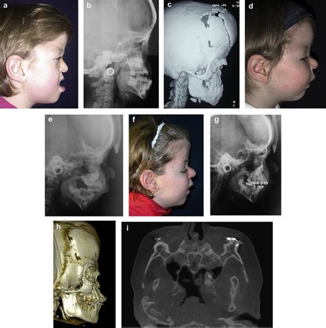 Female Patient Affected By Apert Syndrome A Facial Profile Picture