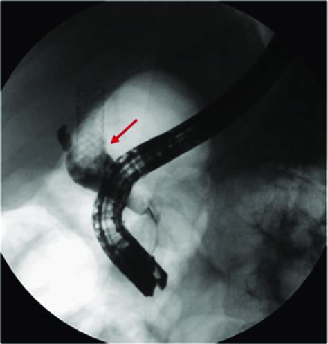 Cholangiogram From Ercp Showing Complete Occlusion Arrow Due To