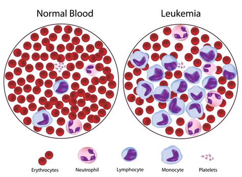 What Causes Abnormal Lymphocytes With Pictures