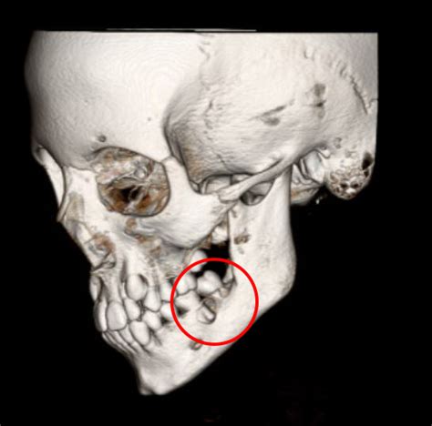 Giant Cell Tumor Of The Jaw Dell Childrens Craniofacial Team Of Texas