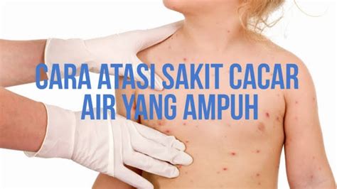 cara mengobati cacar air agar cepat kering dan hilang - YouTube