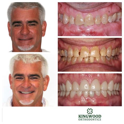 Before And Afters Kingwood Orthodontics