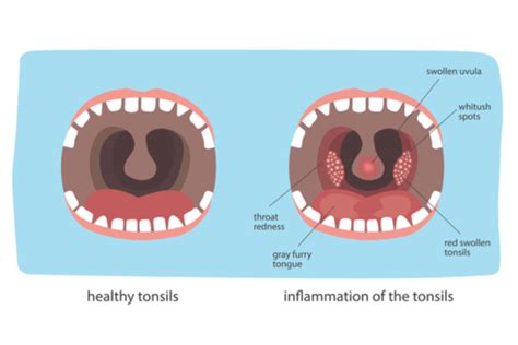 Abnormal Tonsils Children