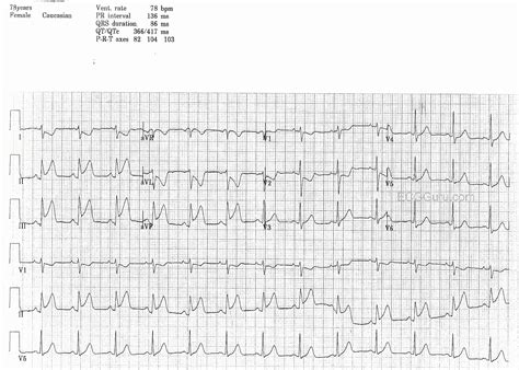 Inferior Wall Mi Ecg Guru Instructor Resources