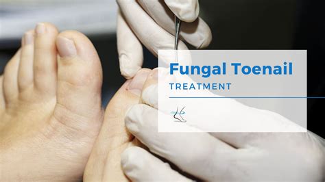 Fungal Toenail Cure And Treatment Moore Foot And Ankle Specialists