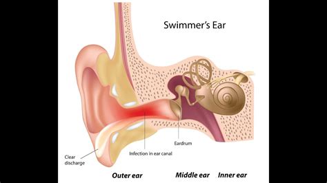 What Causes External Otitis Doctor At Home Pv