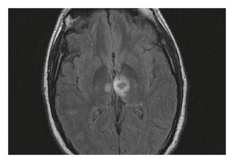 Magnetic Resonance Imaging Where A Bilateral Acute Thalamic Infarction