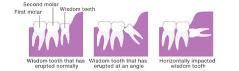 25 Erupting Wisdom Teeth Pics Teeth Walls Collection For Everyone