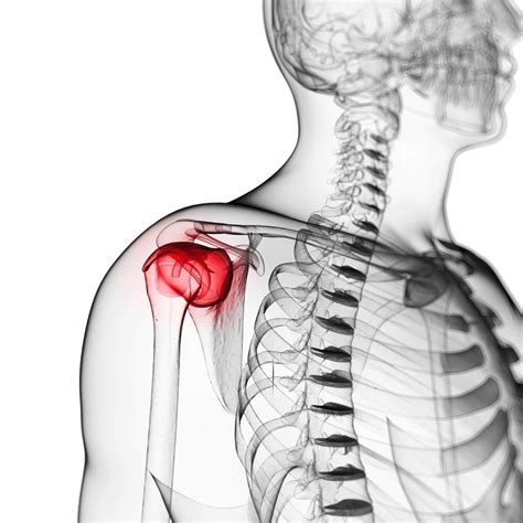 Comparative Effectiveness Of Injection Therapies In Rotator Cuff