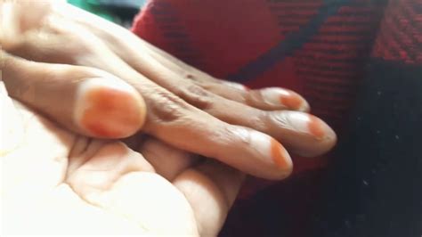 Grade 4 Clubbing Of Fingernails In Cyanotic Heart Disease Tof